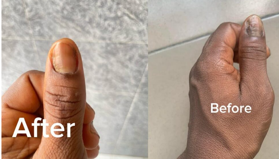 Nail fungus before and after result