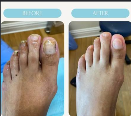 Nail fungus before and after result