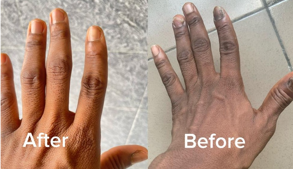 Nail fungus before and after result