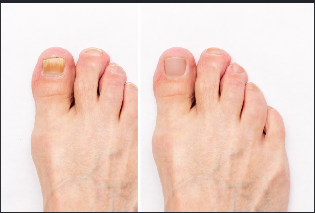 Nail fungus before and after result